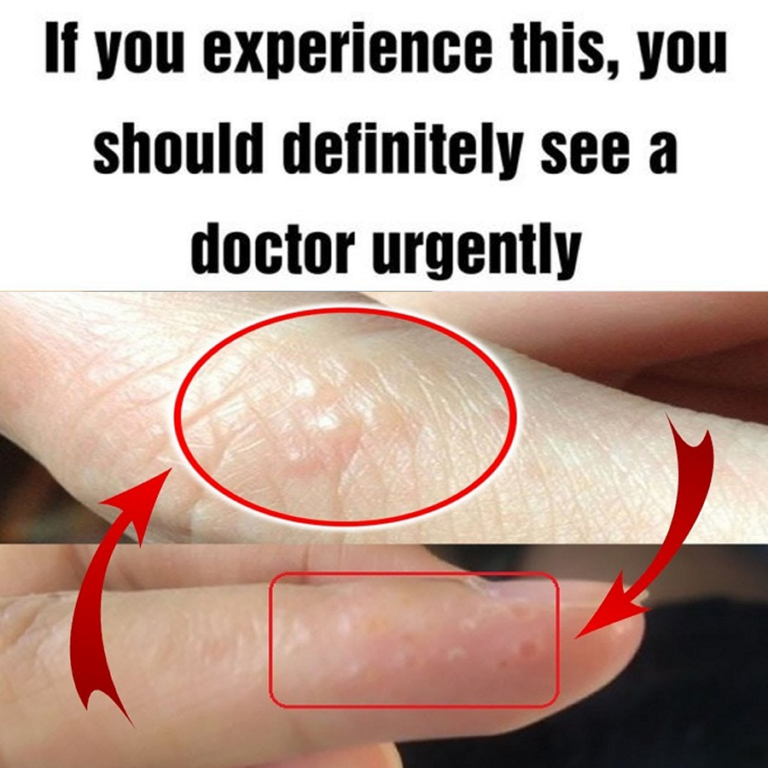 If You See These Painful Red Bumps, You May Have Dyshidrotic Eczema